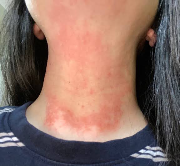 ただの乾燥…って甘くみてちゃダメよぉ〜😱💥