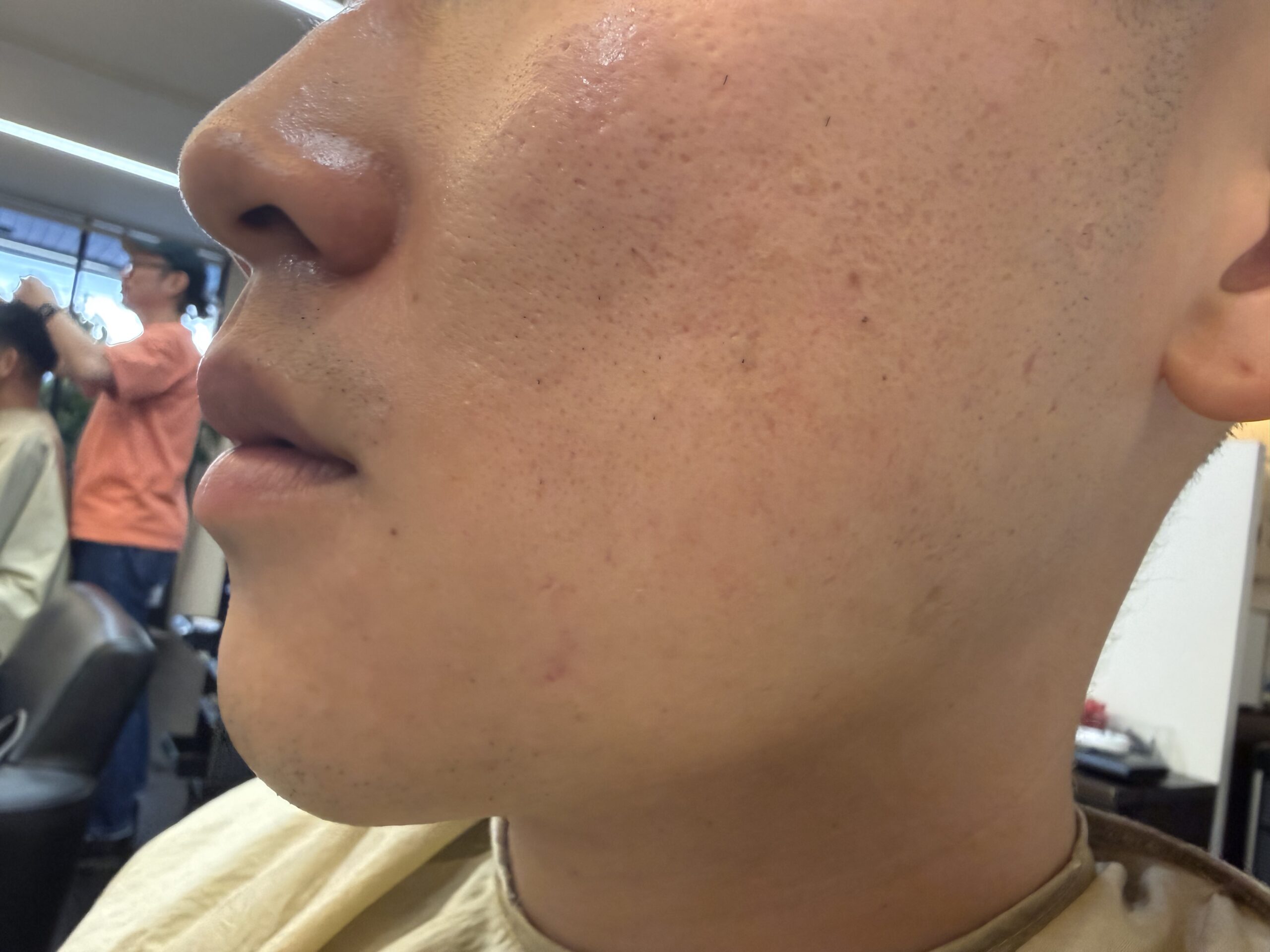 ヒゲ脱毛すると肌荒れともおさらばできちゃう🤭👋