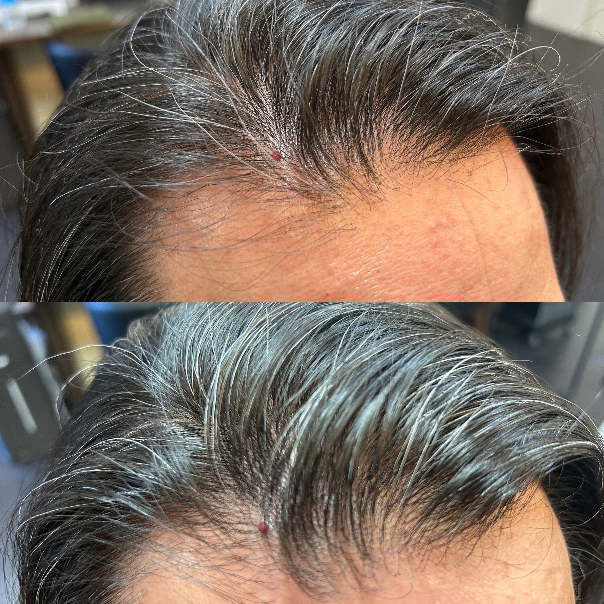 育毛モニター1ヶ月目　途中経過